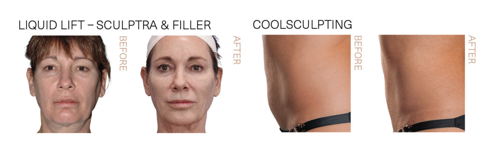 Coolsculpting - Dr. Gustav Lo